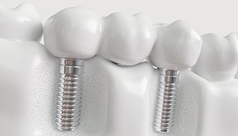 A digital image of an implant bridge in Jacksonville replacing three missing teeth