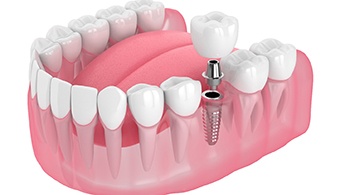 A single tooth dental implant in Jacksonville and all its parts located on the lower arch