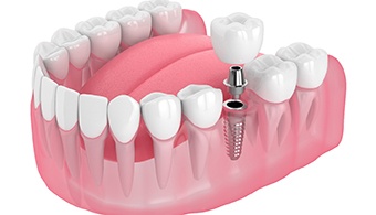 A single tooth dental implant in Jacksonville and all its parts located on the lower arch