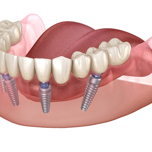 Digital diagram of All-On-4 dental implants in Jacksonville on white background