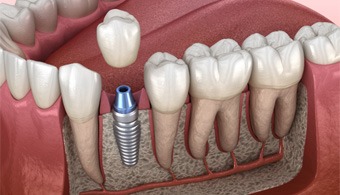 Single dental implant in Jacksonville, FL in jaw about to receive dental crown