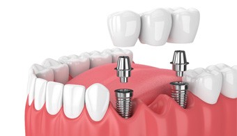 Dental bridge being attached to dental implants in Jacksonville, FL