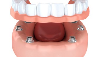 Denture for lower arch being attached to dental implants in Jacksonville, FL