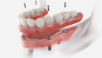 A 3D illustration of all-on-4 dentures