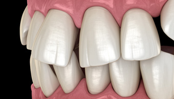 Illustration of gapped teeth