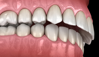 Illustration of an overbite