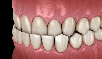 Illustration of an underbite