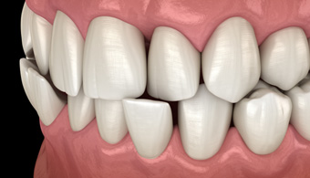 Illustration of a crossbite