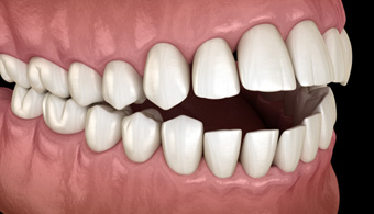 Illustration of an open bite