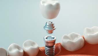 a computer illustration showing the different parts of a dental implant