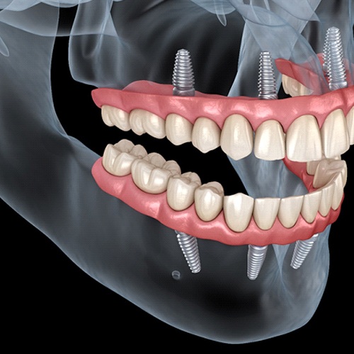 Implant Dentures Jacksonville Missing Teeth Jacksonville Dental