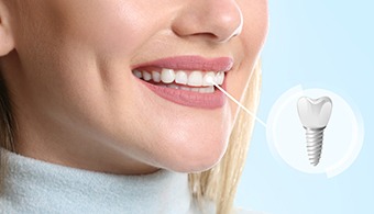 A woman who just had her dental implant’s restoration attached