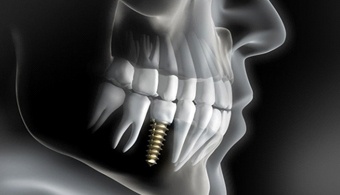 X-ray of a person with a single dental implant