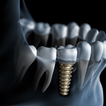 Animated smile with dental implant supported dental crown