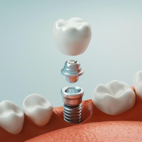 Animated dental implant supported dental crown placement