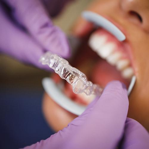 Dentist placing Invisalign in Jacksonville, FL in a patient’s mouth