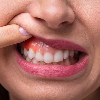 Closeup of inflamed gum tissue before gum disease treatment