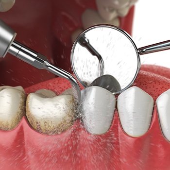 Animated smile during periodontal therapy