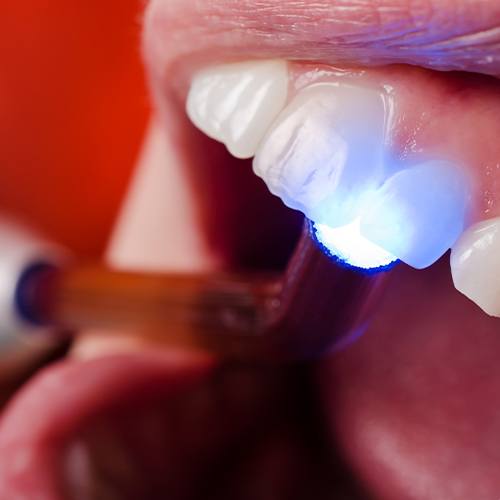 Patient receiving dental sealants