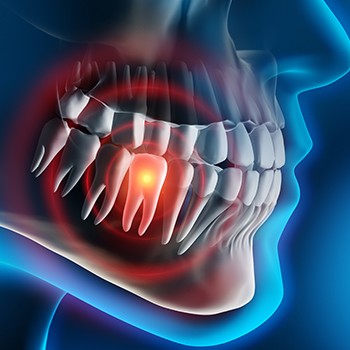 Aniamted smile with highlighted tooth indicating emergency dentistry