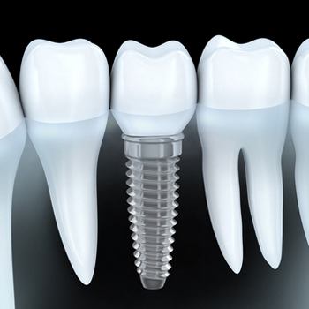 Animated dental implant supported dental crown