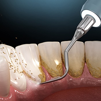Animated smile during periodontal therapy