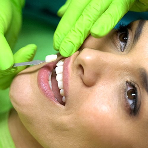 Woman having veneers placed