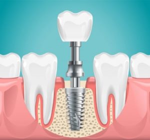 Graphic of a dental implant replacing a molar.