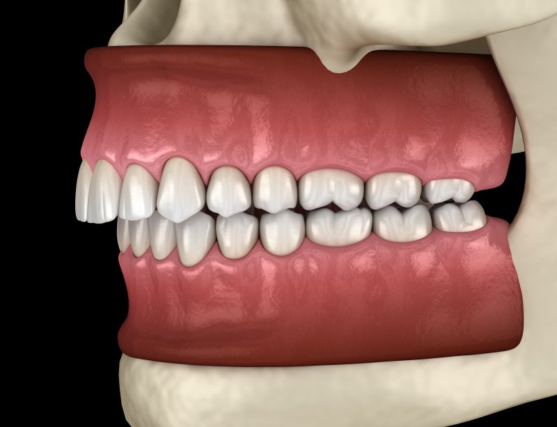 digital image of a severe overbite 