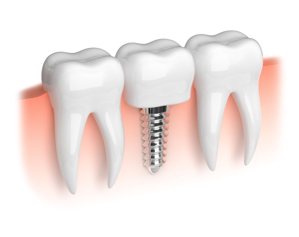 Dental implant between natural teeth