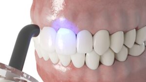Illustration of curing light being used to harden dental bonding